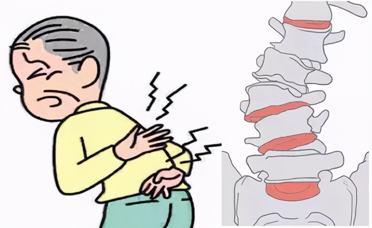 腰椎退变侧弯是什么意思,年轻人腰椎退行性改变是怎么回事