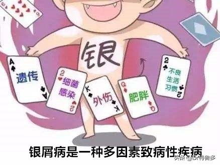 牛皮癣导致关节肿痛如何止痛,得了牛皮癣能治愈吗