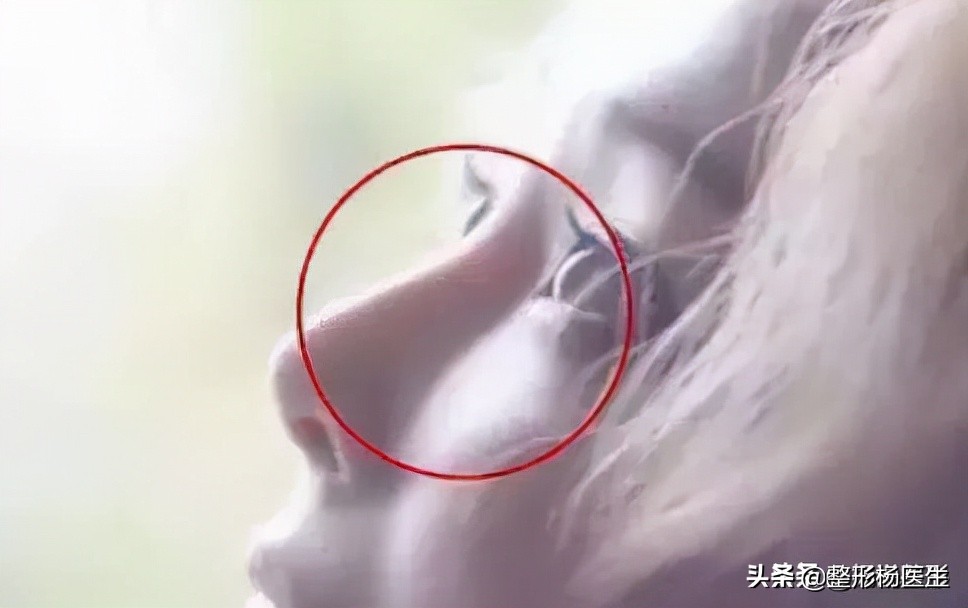 隆鼻整容老了会怎么样,隆鼻后老了