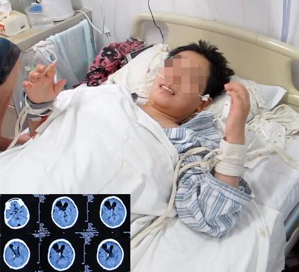 结核性脑积水,脑膜炎脑积水要治疗多久