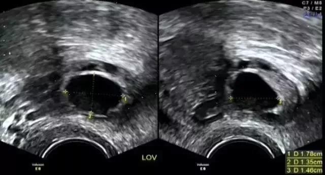 卵泡长得好不好要做什么检查,卵泡监测几个卵泡最适合