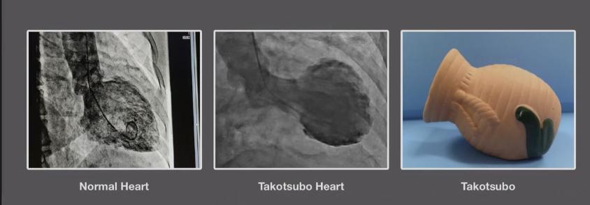 人心碎了会变成什么样,原来人伤心的时候真的会心脏痛