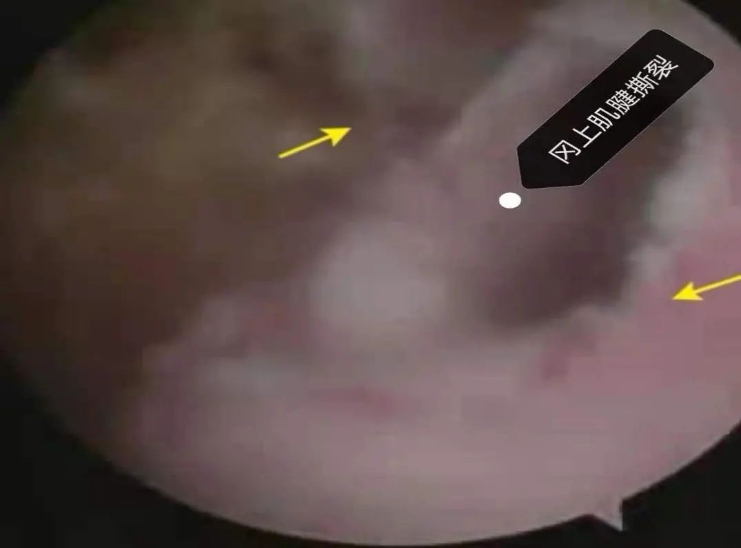 手麻肌电图检查过程视频,手麻脚麻肌电图正常