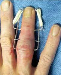 打篮球脚踝扭伤拍片显示没有伤到,打篮球手指挫伤和骨折怎么分辨