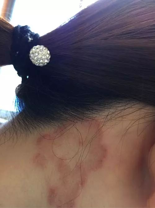 猫奶癣和猫癣分辨,奶藓和猫藓的区别有哪些