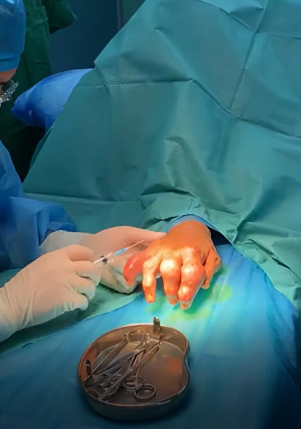 深圳哪家医院痛风石最好,正康骨科痛风