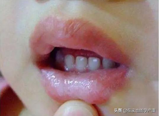 宝宝鹅口疮反复很烦人？试试小儿推拿手法，太有用了！
