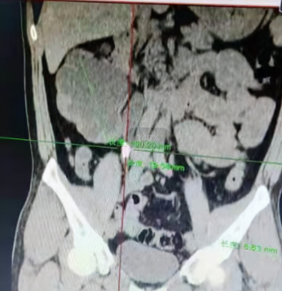 男性肾结石掉到输尿管了怎么排,左肾积水左输尿管结石严重吗