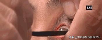 成都刀锋洗眼洗出虫子,刀锋洗眼可以做吗