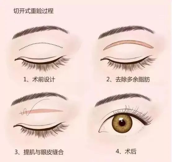 高考之后割双眼皮填志愿怎么办,高考生暑期扎堆割双眼皮