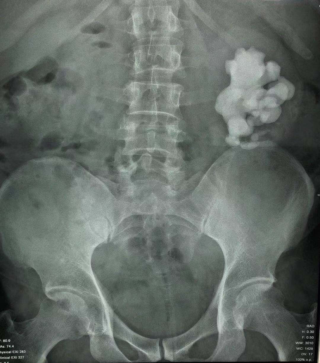 鹿角型结石最严重的后果,疯狂的石头肾脏