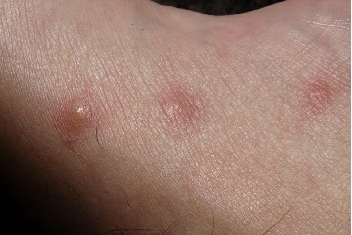 如何判断婴儿湿疹还是脂溢性皮炎,宝宝脂溢性皮炎是干性湿疹吗