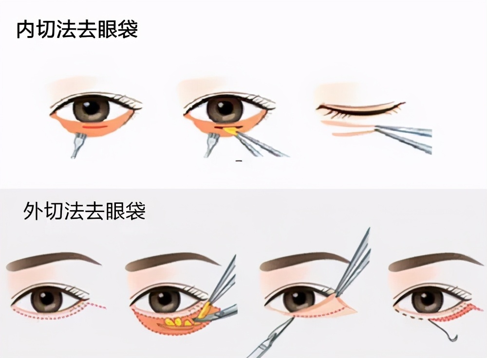 眼袋是怎样治疗,眼袋有什么解决方法