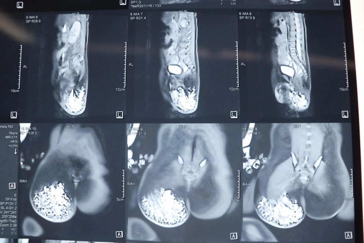 宝宝屁股上有硬块血管瘤,婴儿大腿淋巴管瘤囊肿