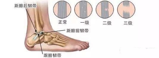 人总是崴脚怎么回事,孩子总爱崴脚怎么回事