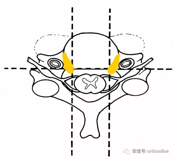 颈椎病骨质增生能治疗断根吗,颈椎病骨质增生锻炼教学视频