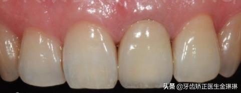 烤瓷牙黄可以通过刷牙变白吗,烤瓷牙能变白吗