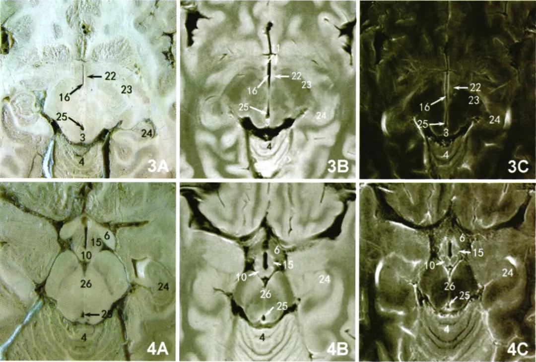 下丘脑核团解剖,丘脑mri断层解剖图