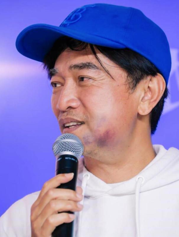 吴宗宪嘴肿,吴宗宪的脸淤青怎么回事