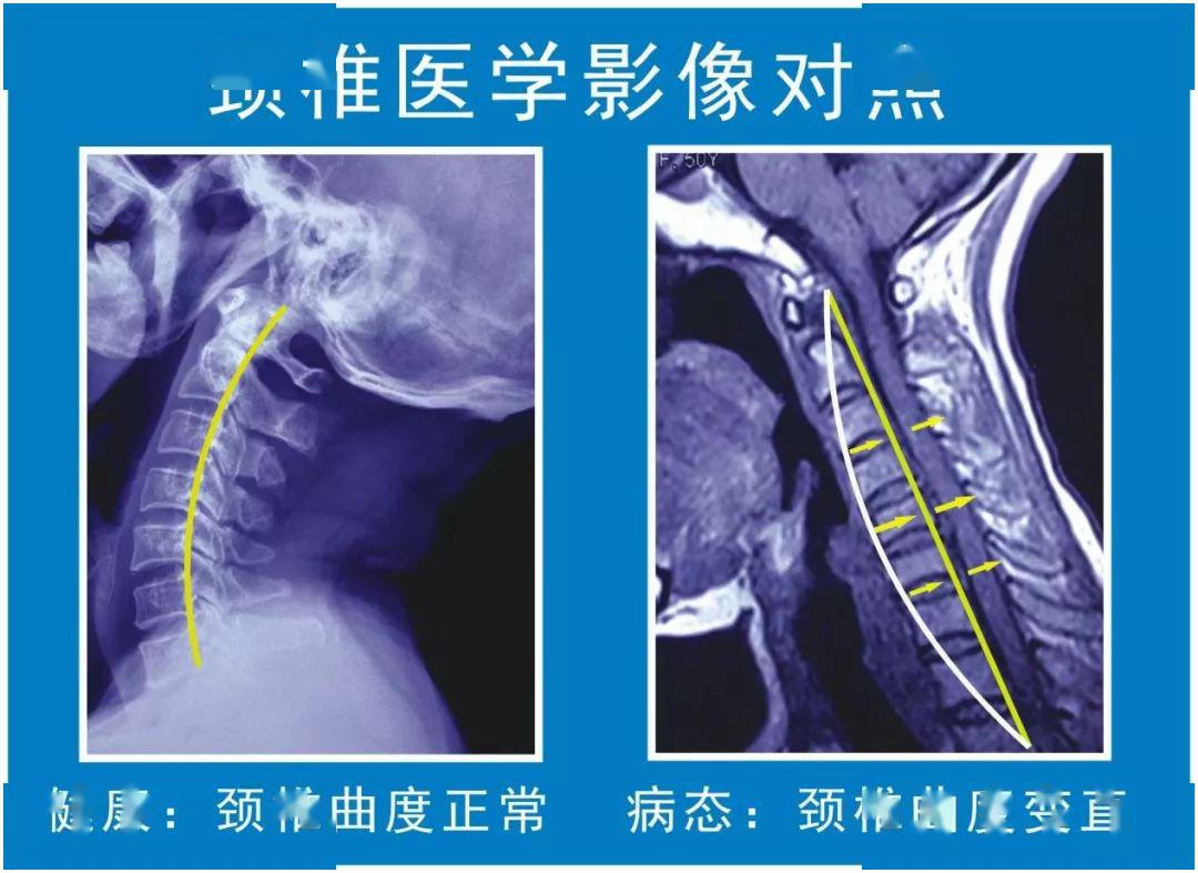 颈椎曲度康复案例,颈椎病康复科普文章图片