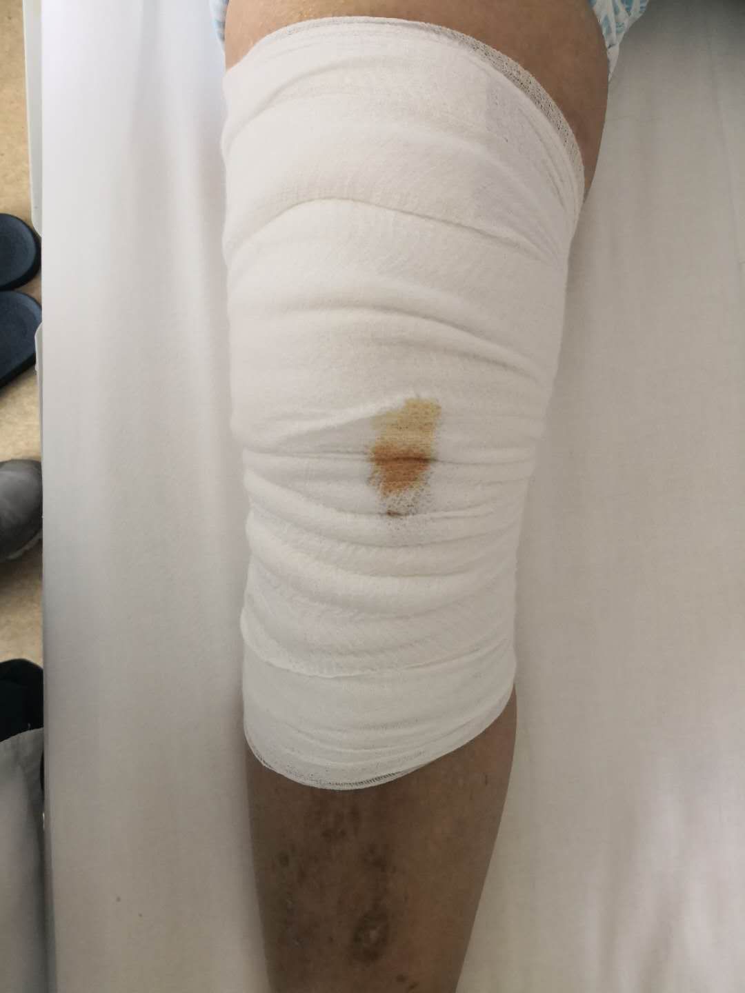 髋膝关节置换术操作规范2022版,髋骨关节置换术后康复锻炼