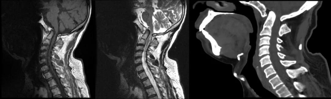 先天性颅脑发育不全,先天颅脑发育不良能治吗
