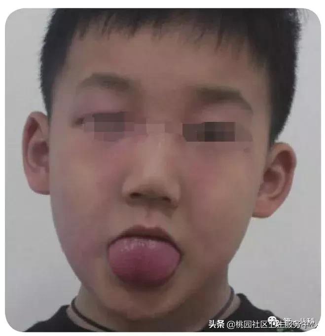 手足口病及水痘等传染病防控知识,手足口病和幼儿急疹和水痘的区别