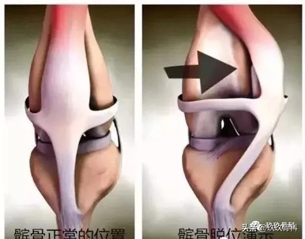 膝盖疼原来是腿向跑偏,膝盖走不准就疼一下是咋回事