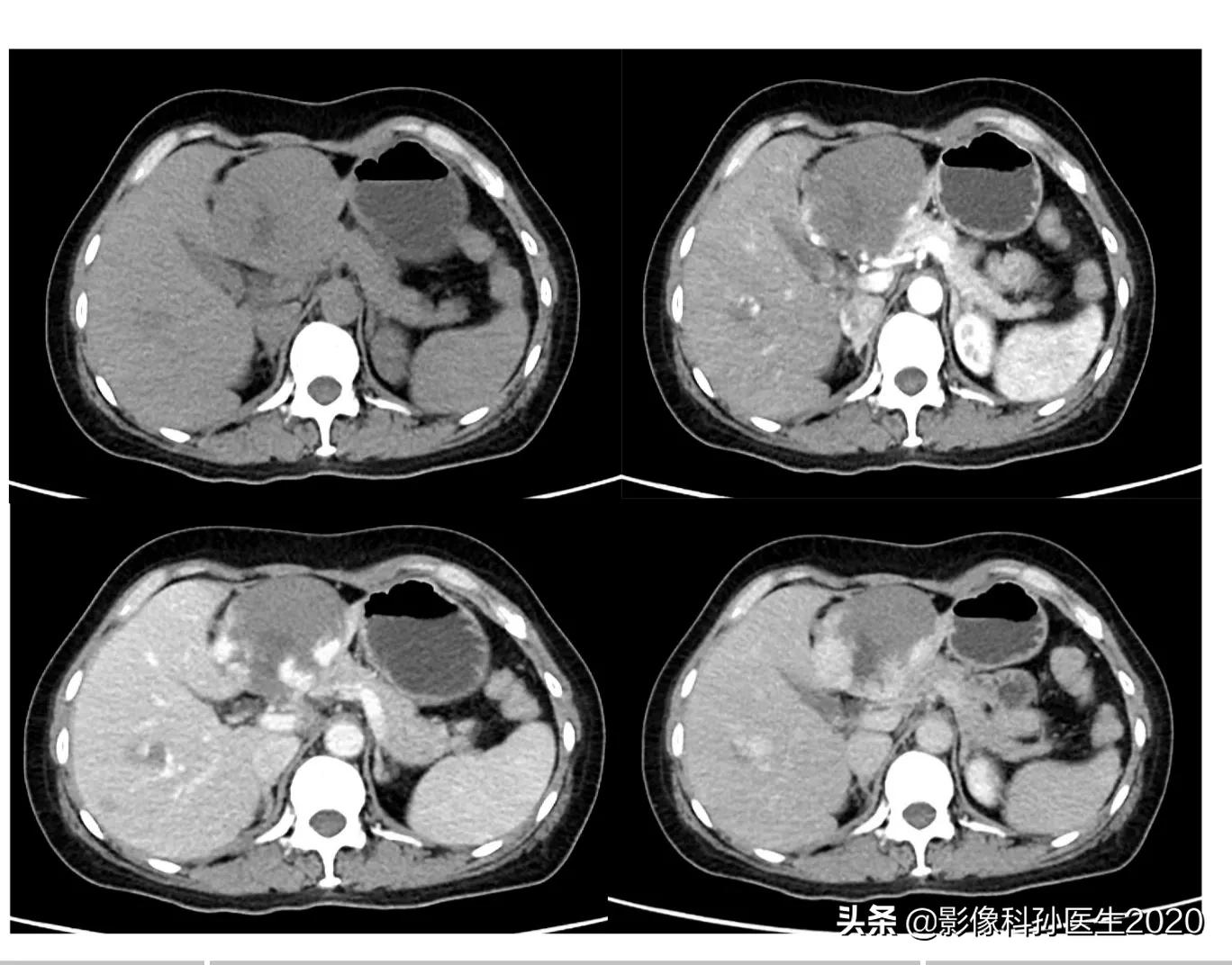 肝上皮样血管内皮瘤全国多少例,肝上皮样血管内皮瘤超声表现