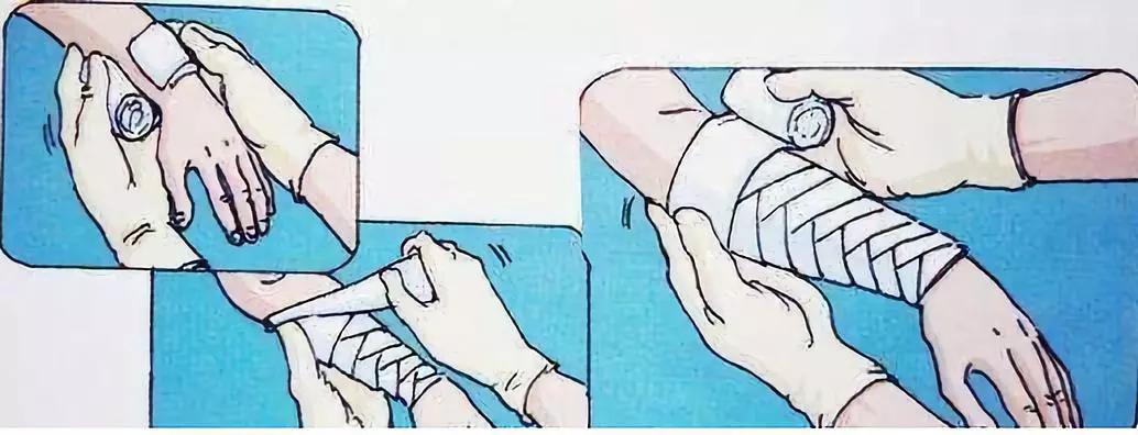 家人用皮筋包扎伤口结果导致截肢,截肢患者弹力绷带包扎法