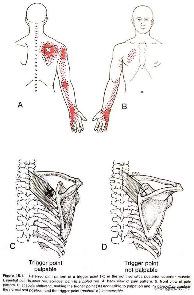 肩胛疼痛为何要做康复,肩胛区疼痛治疗