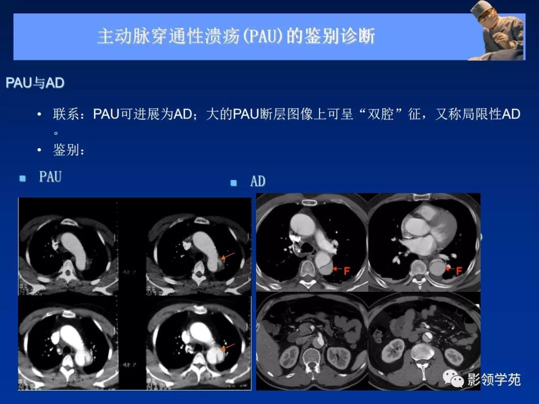 主动脉夹层壁间血肿如何鉴别,主动脉夹层血肿溃疡