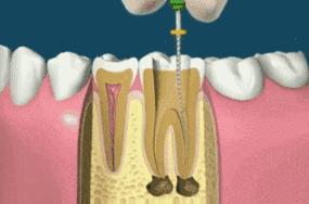 根管治疗后牙齿感觉不到味道,根管治疗后牙齿不咬东西也会酸