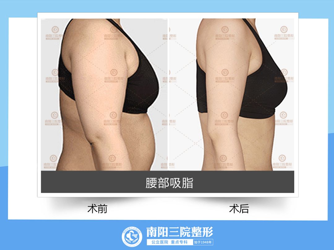 吸脂手术一秒变瘦,做了吸脂手术再减肥还能瘦么