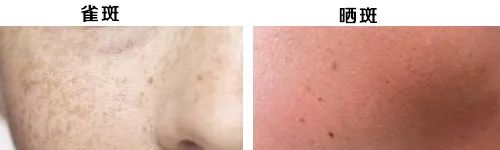 雀斑和晒斑怎么区别,脸上有晒斑雀斑黄褐斑怎么办