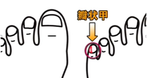 汉人的小脚趾盖有什么特征,汉人的小脚趾是两瓣的是什么原因