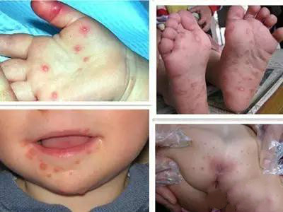 最近中招手足口病的宝宝,手足口病夏季高发几岁常见