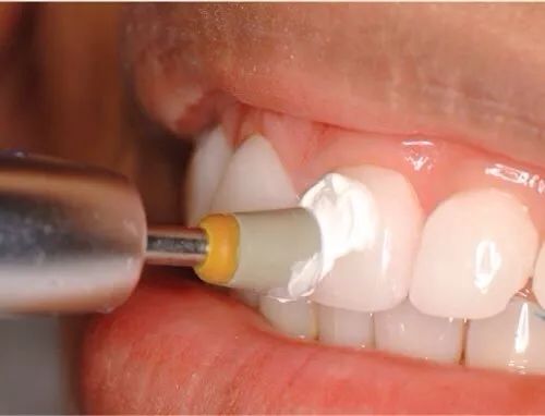 多图直击！牙医如何用抛光把孩子的牙洗干净？#葉子口腔科普#