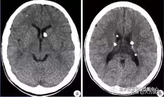 钙化灶是良性肿瘤的可能性大吗,颅内肿瘤钙化发生率最高
