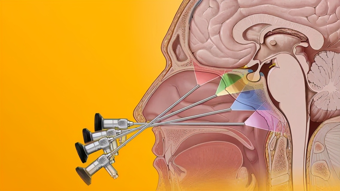 脑垂体病变的面相图解,脑垂体腺瘤面相图片