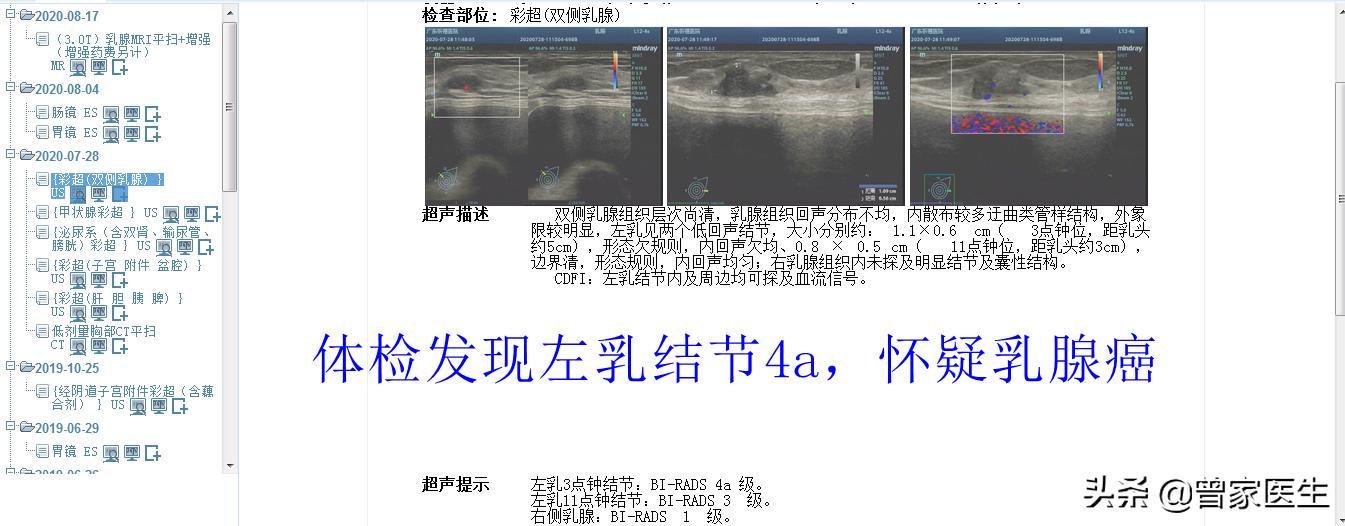 乳腺彩超4a报告单怎样描述的,乳腺彩超birads4a类严重吗