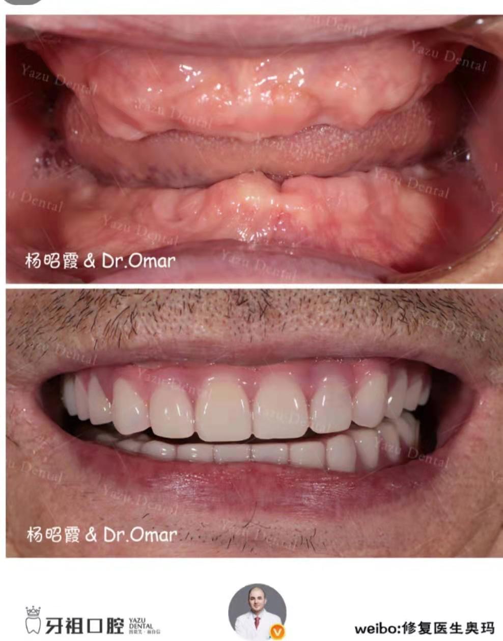 半固定种植牙几个牙钉,球帽式半固定种植牙优缺点