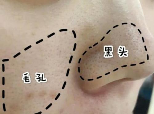 女生最怕“1孔1黑”,特别影响颜值,很多人女生中招还不自知