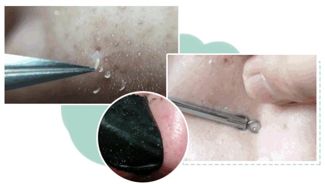 黑头用黑头贴去不掉怎么办,白糖去黑头的正确方法