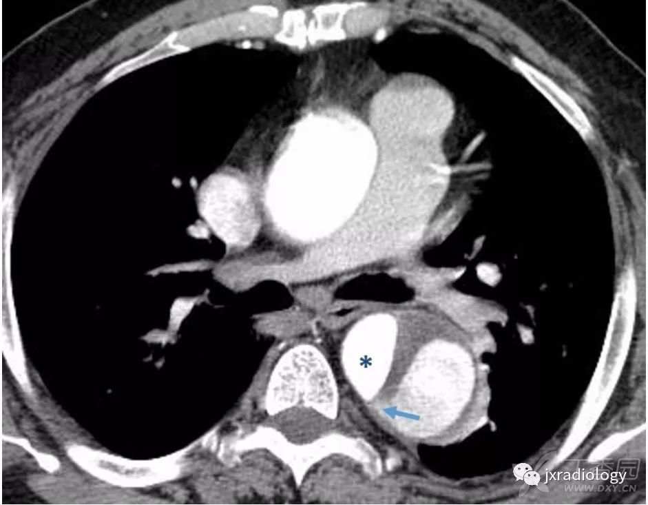 急性主动脉综合征报道,急性主动脉综合征症状