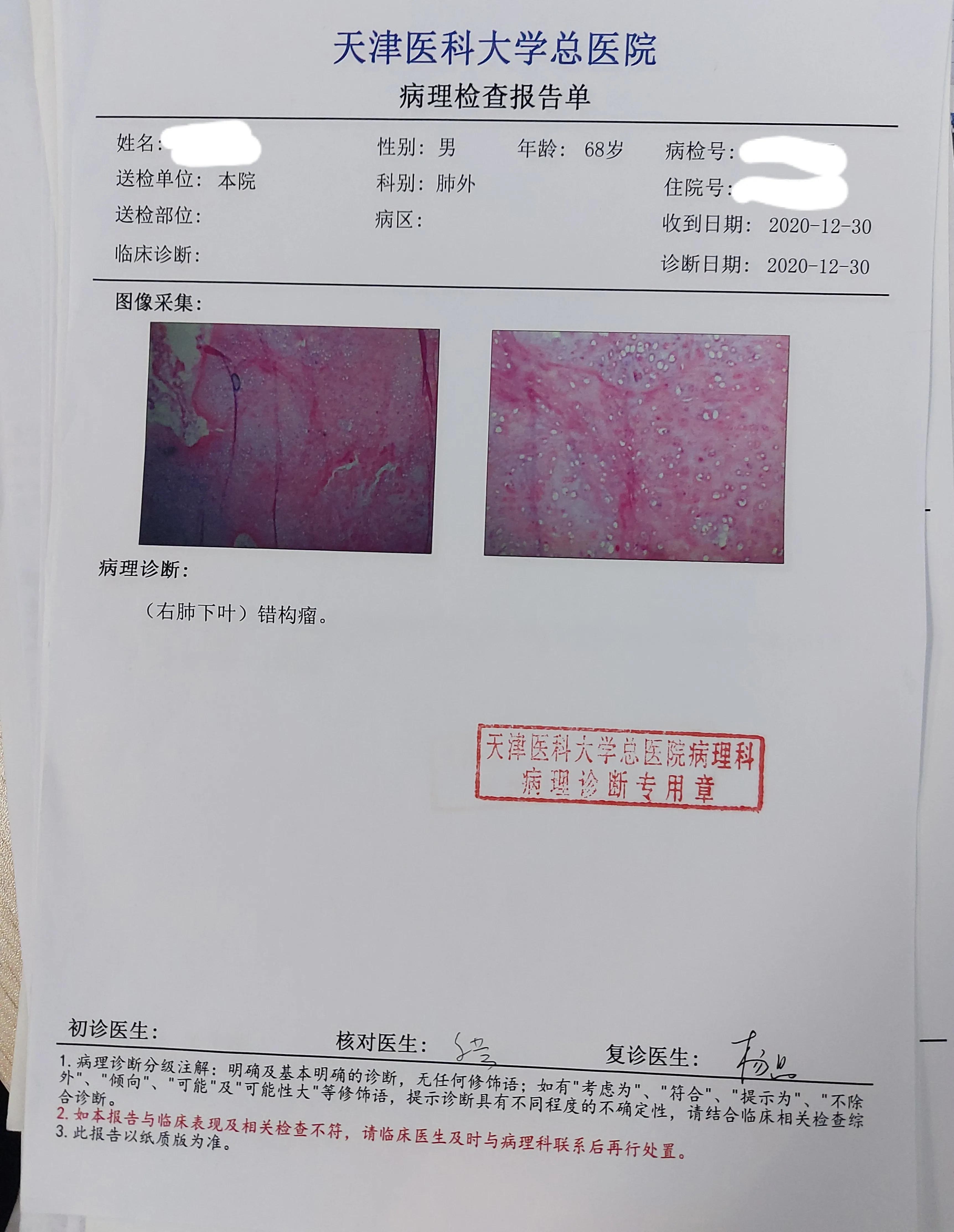 七种自身抗体检测肺癌正常指标,刘懿博士说肺癌免疫治疗