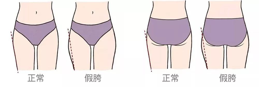 大腿粗屁股肥怎么办,最快最有效改善假胯宽和大腿