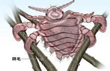 外阴瘙痒买什么药,为什么会外阴瘙痒呢