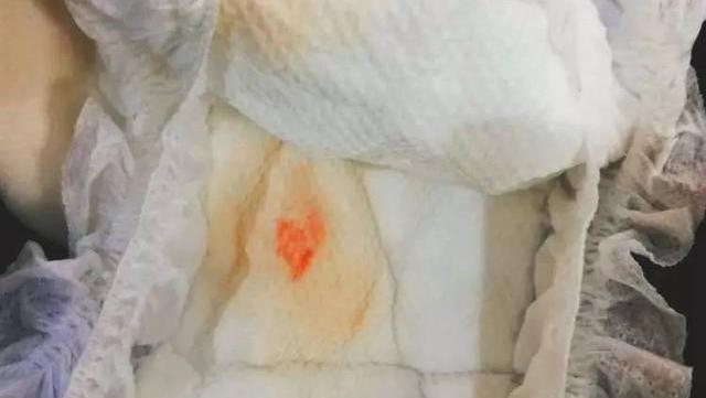 女宝宝外阴有血丝怎么处理,女婴下身有血丝怎么办