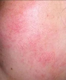 脸上长“*血丝红**”，医生：平时的坏习惯要纠正！